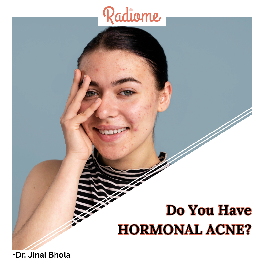 Hormonal Acne: Why It Happens & How to Manage It